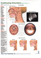 Swallowing Disorders