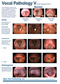 Vocal Pathology V