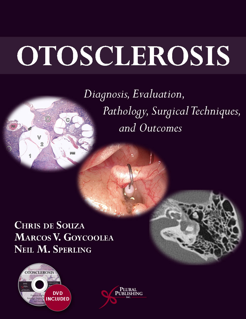 Otosclerosis and stapes surgery — Hearing Institute